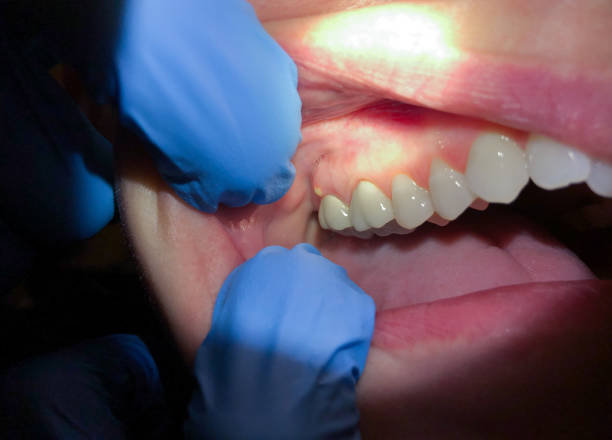 Best Knocked-Out Tooth (Avulsed Tooth) Treatment in Kamas, UT